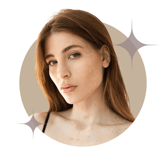 Гиперпигментация кожи